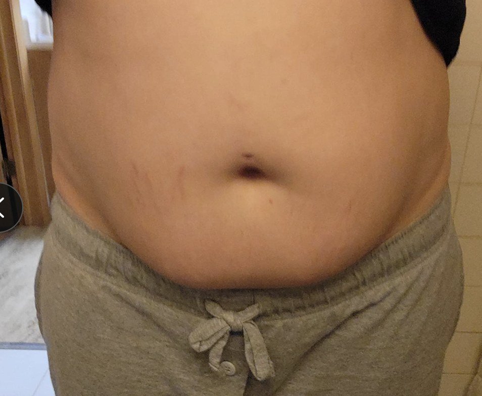 Tummy before wrapping